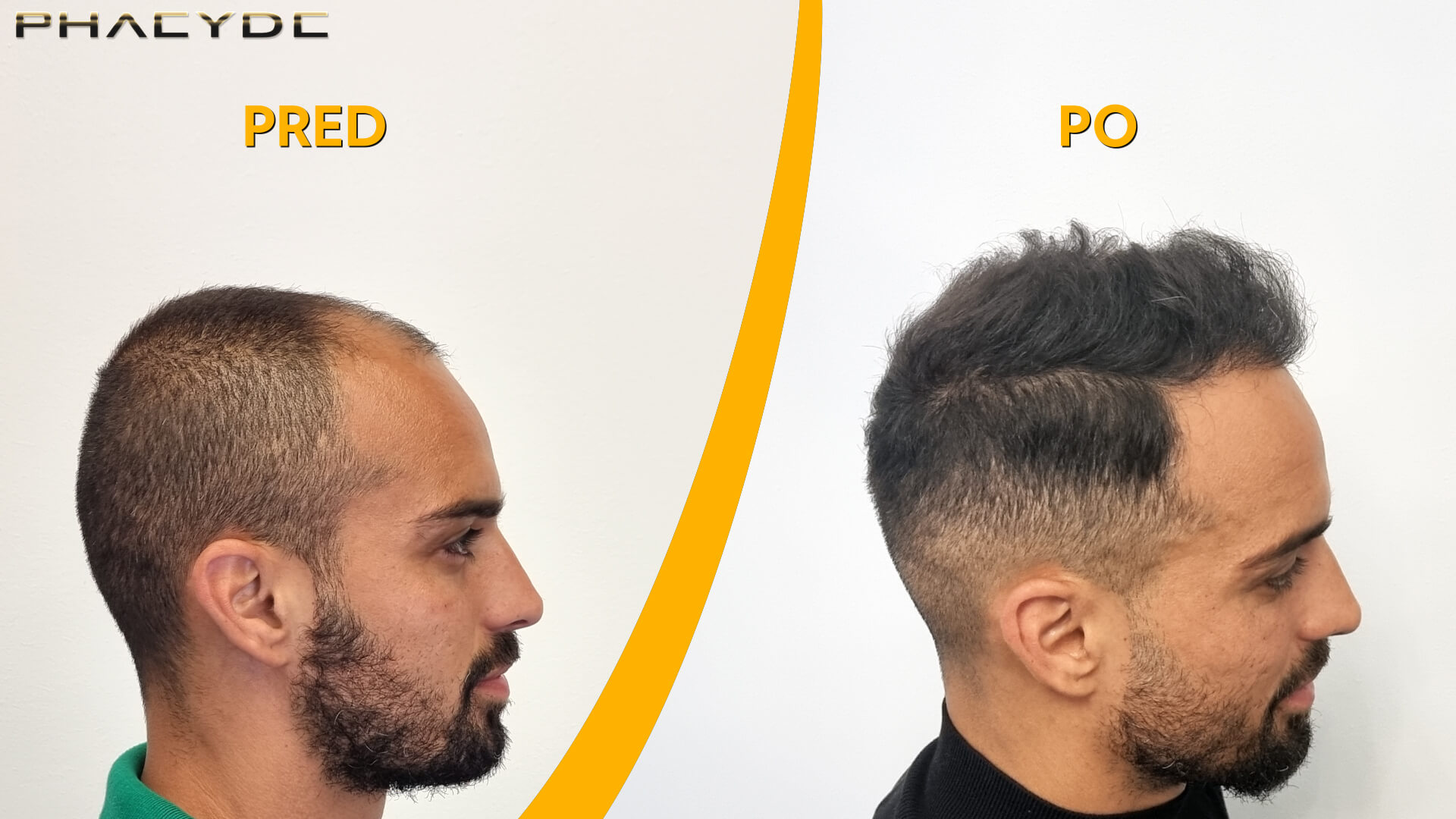 The result of a hair transplant at the PHAEYDE clinic in Budapest