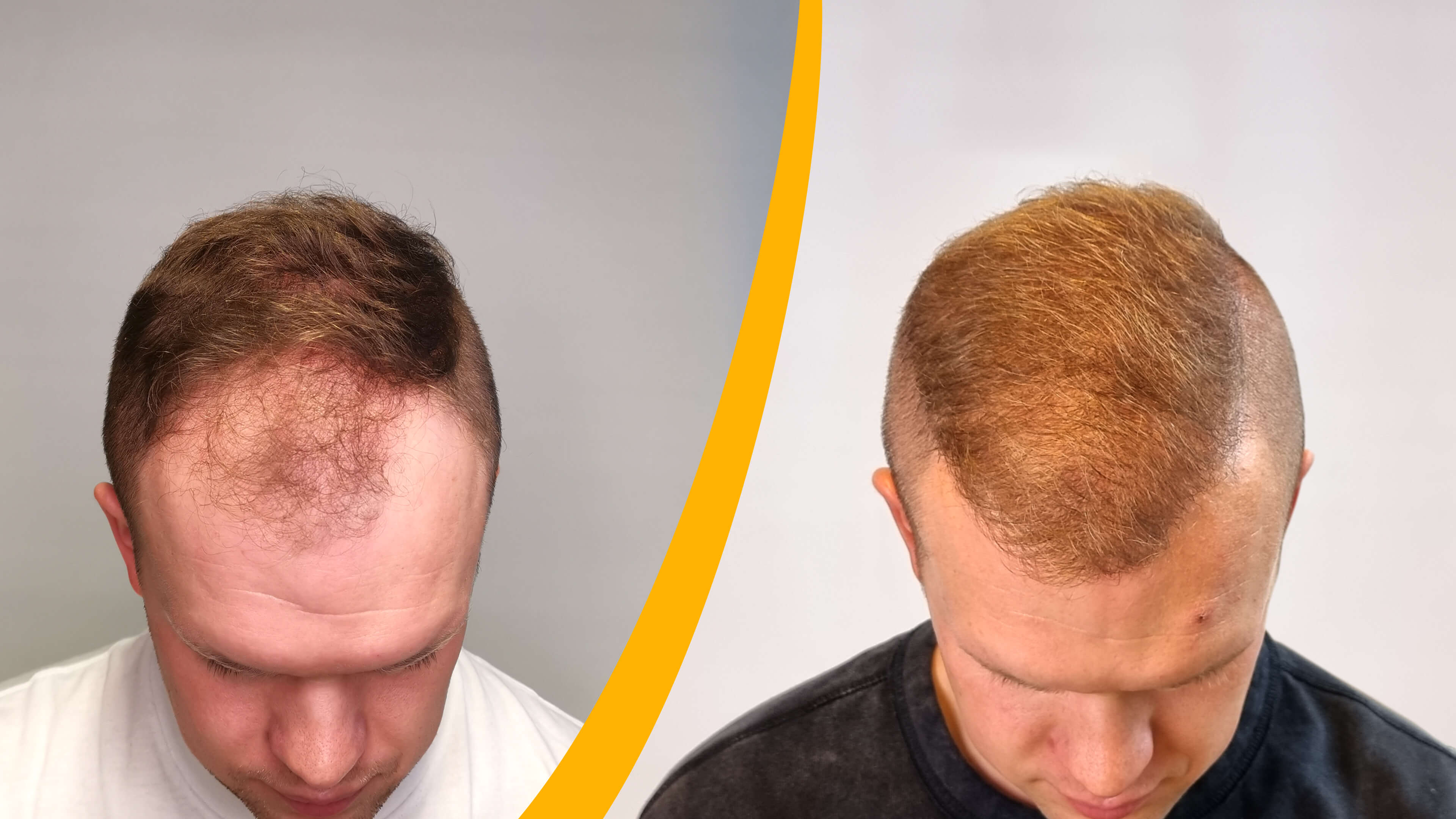 Before-After Hair Transplant result