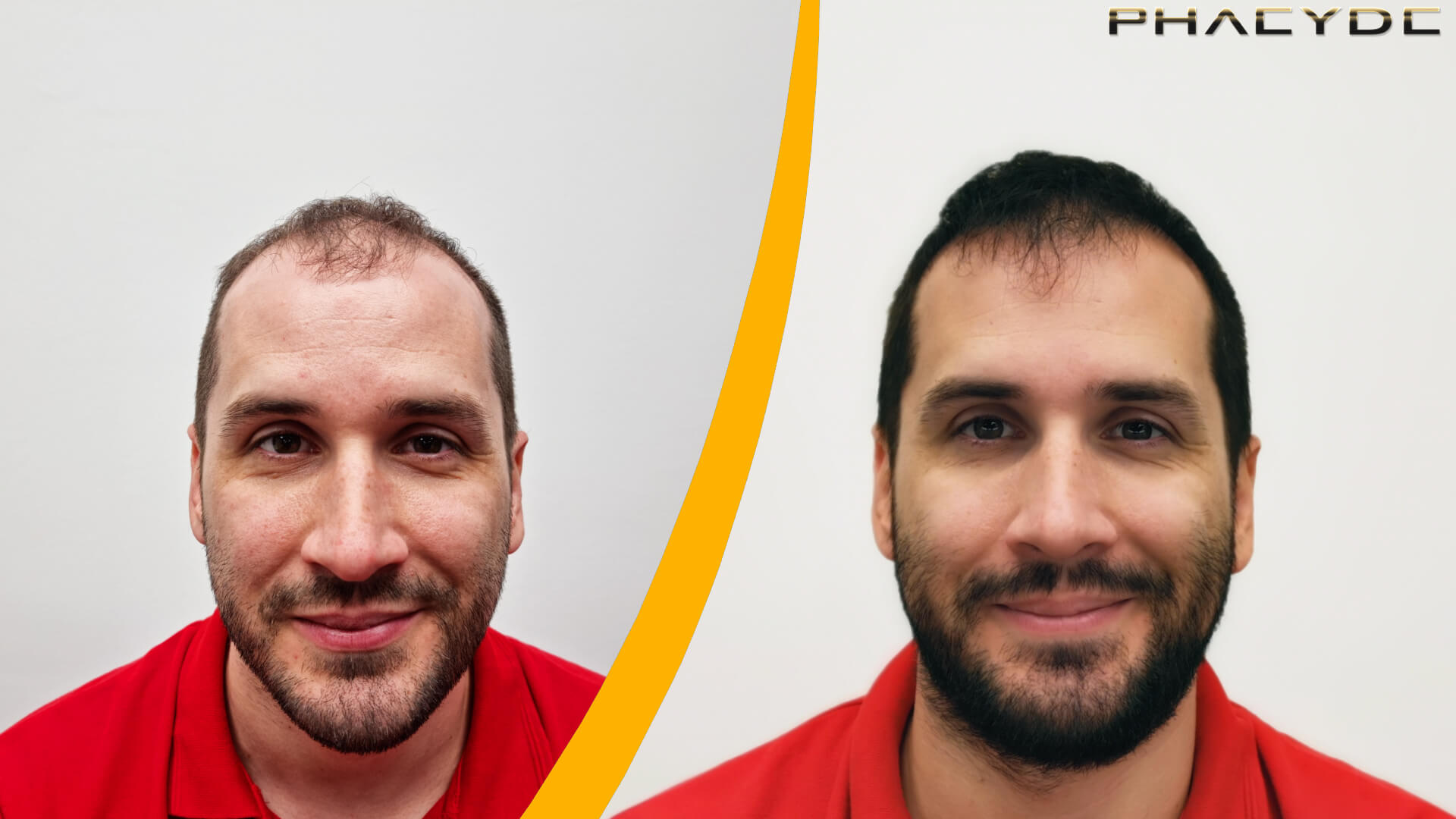 Hair Transplant Before & After Result