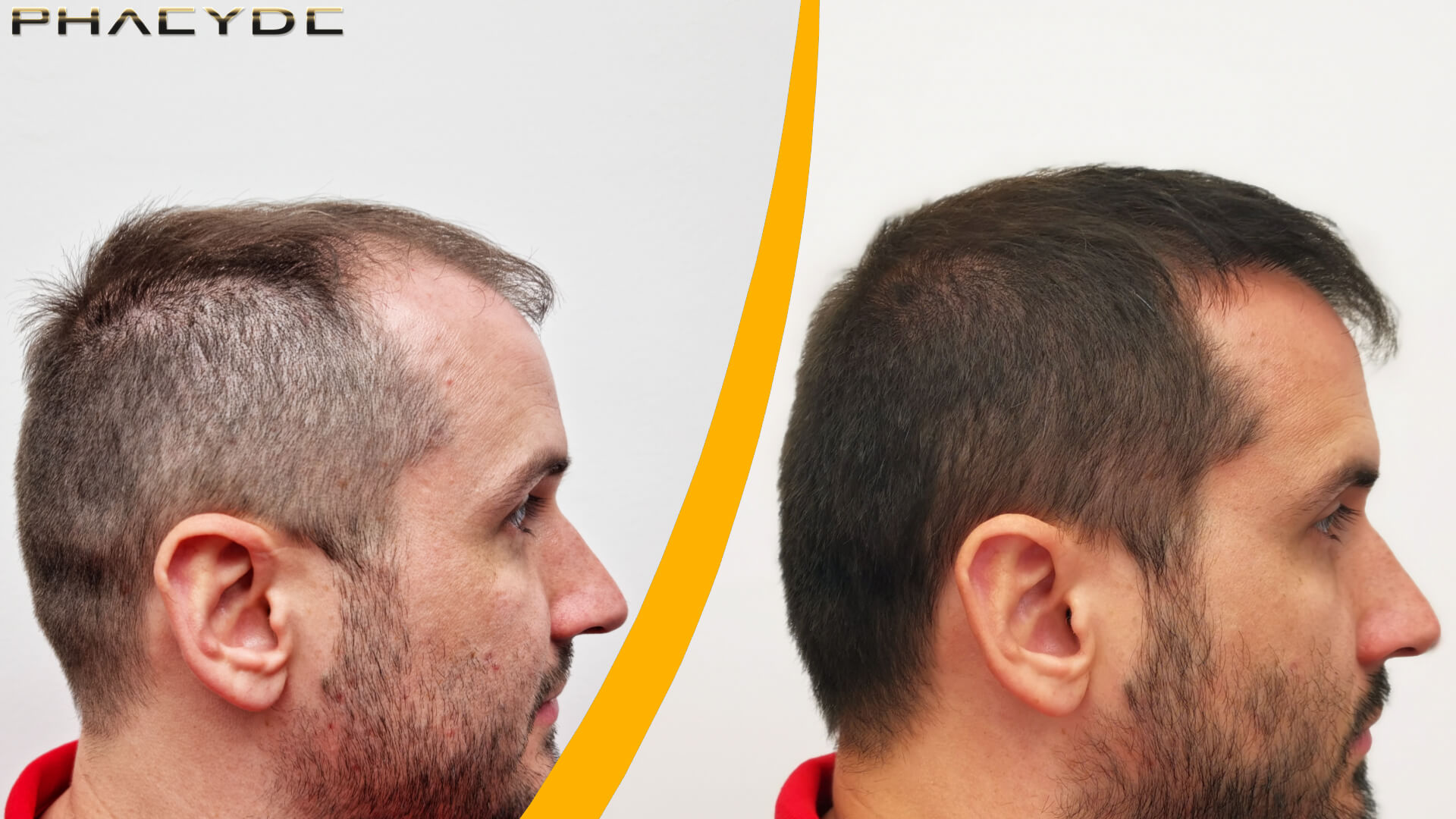 Before & After Hair Transplant