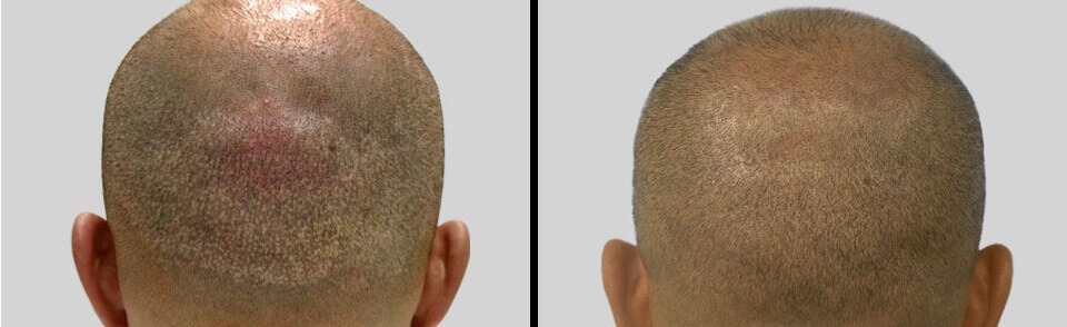 FUE Scar correction before and after