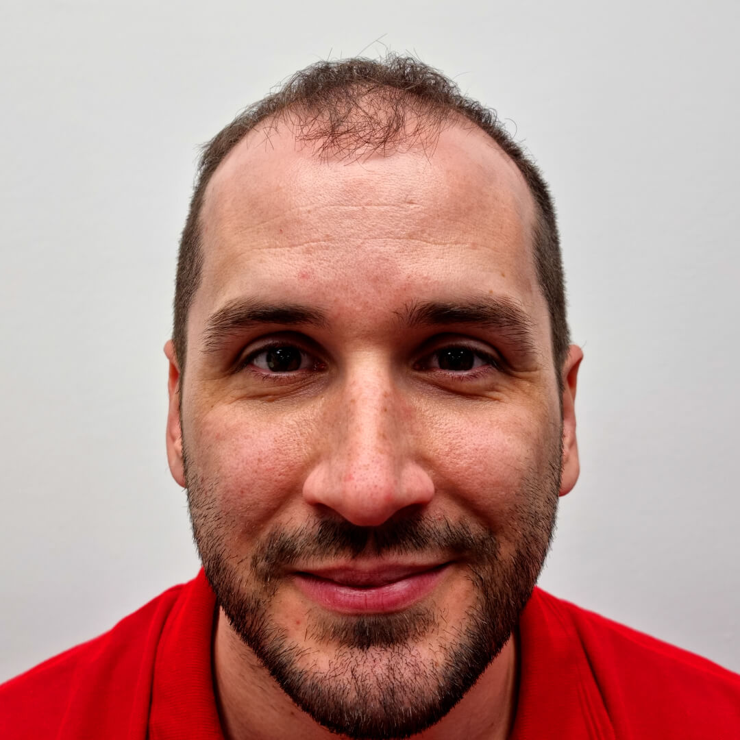 Hair transplant before-after: Norbert - PHAEYDE Clinic