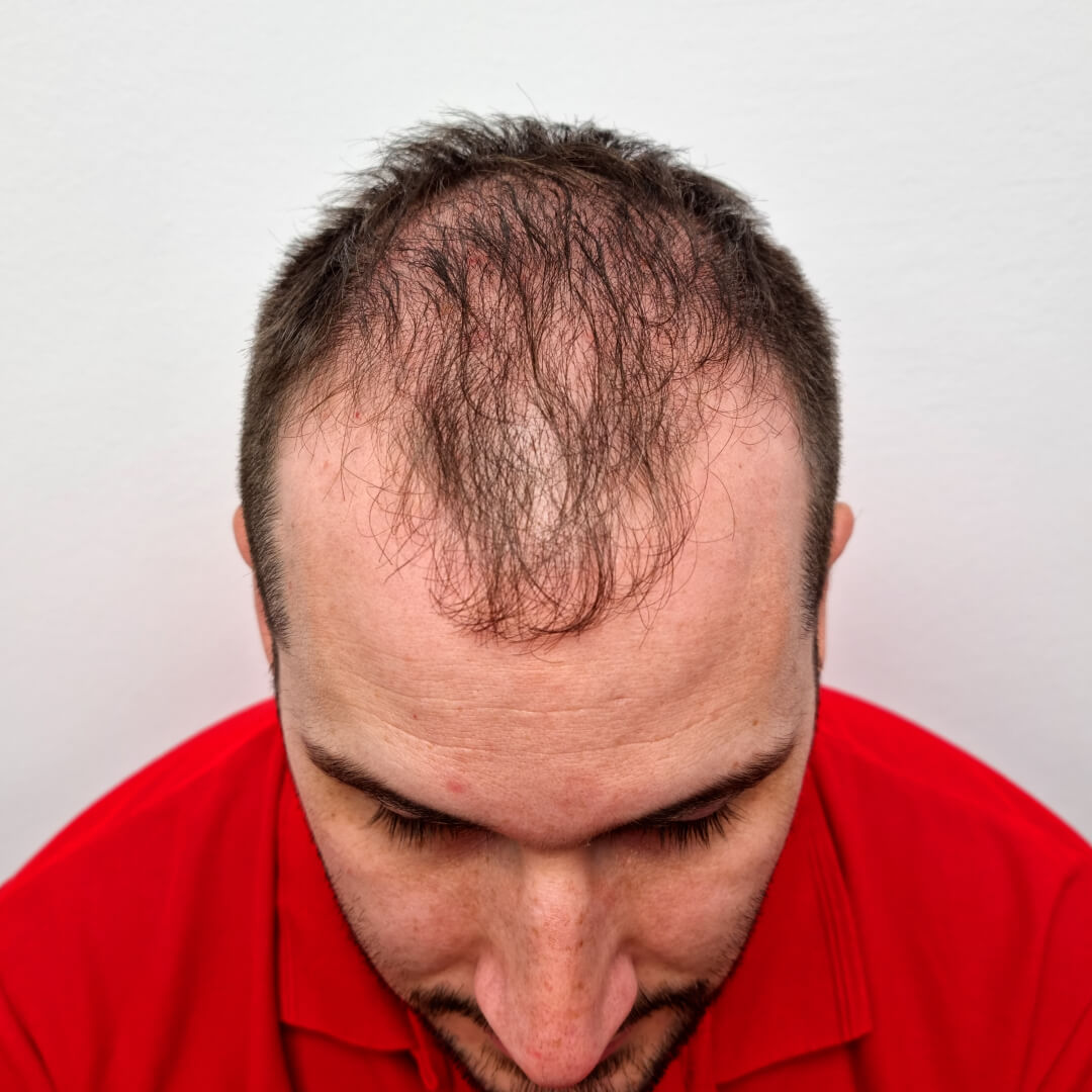 Hair transplant before-after: Norbert - PHAEYDE Clinic