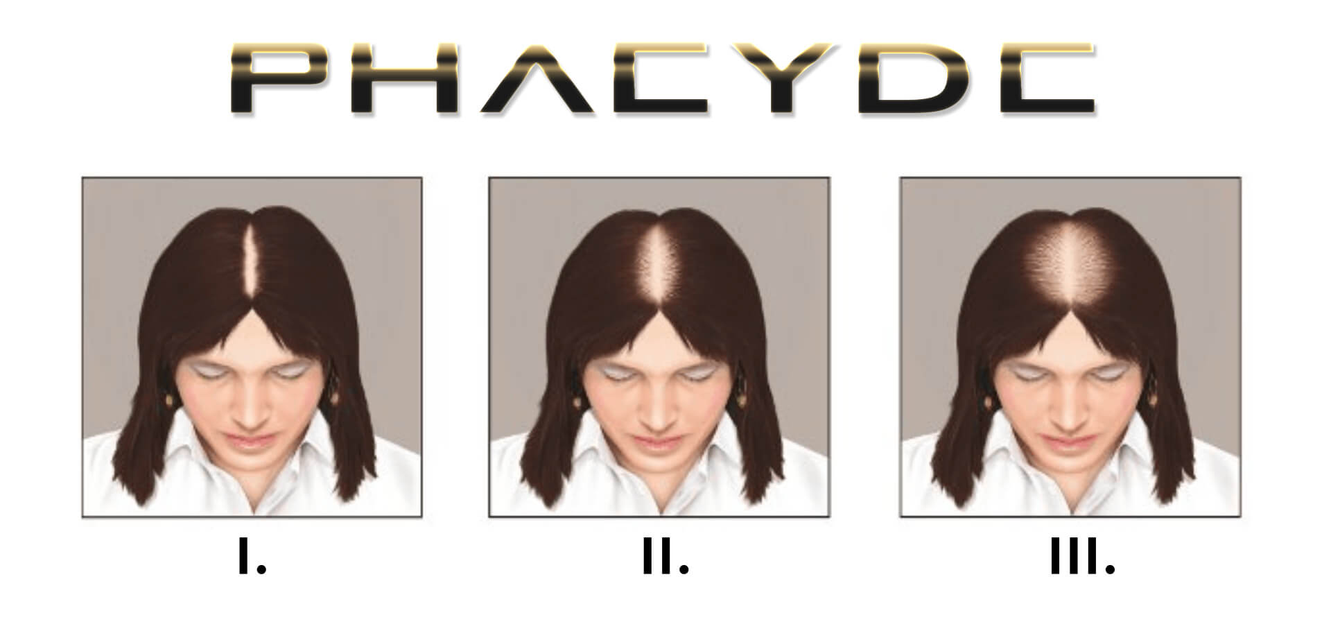 Ludwig Scale: Stages of Women Hair Loss