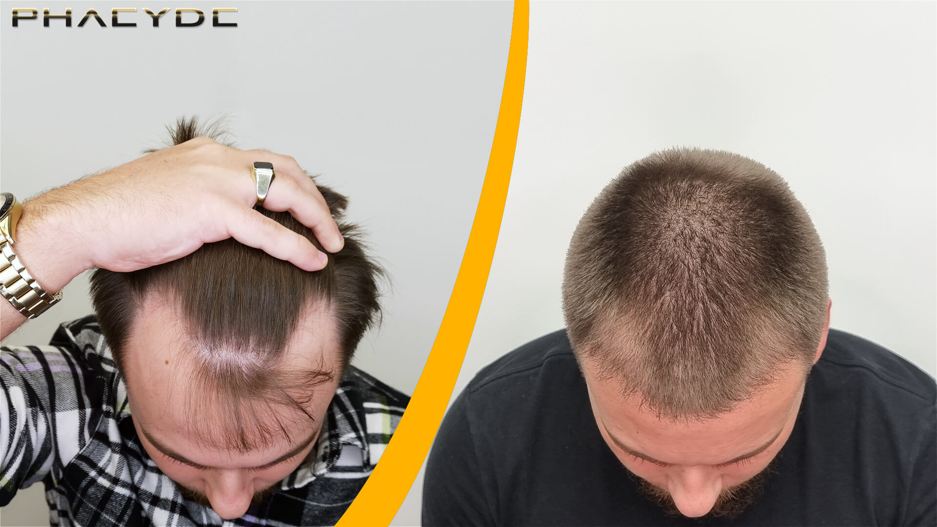 Hair Transplant before & after result