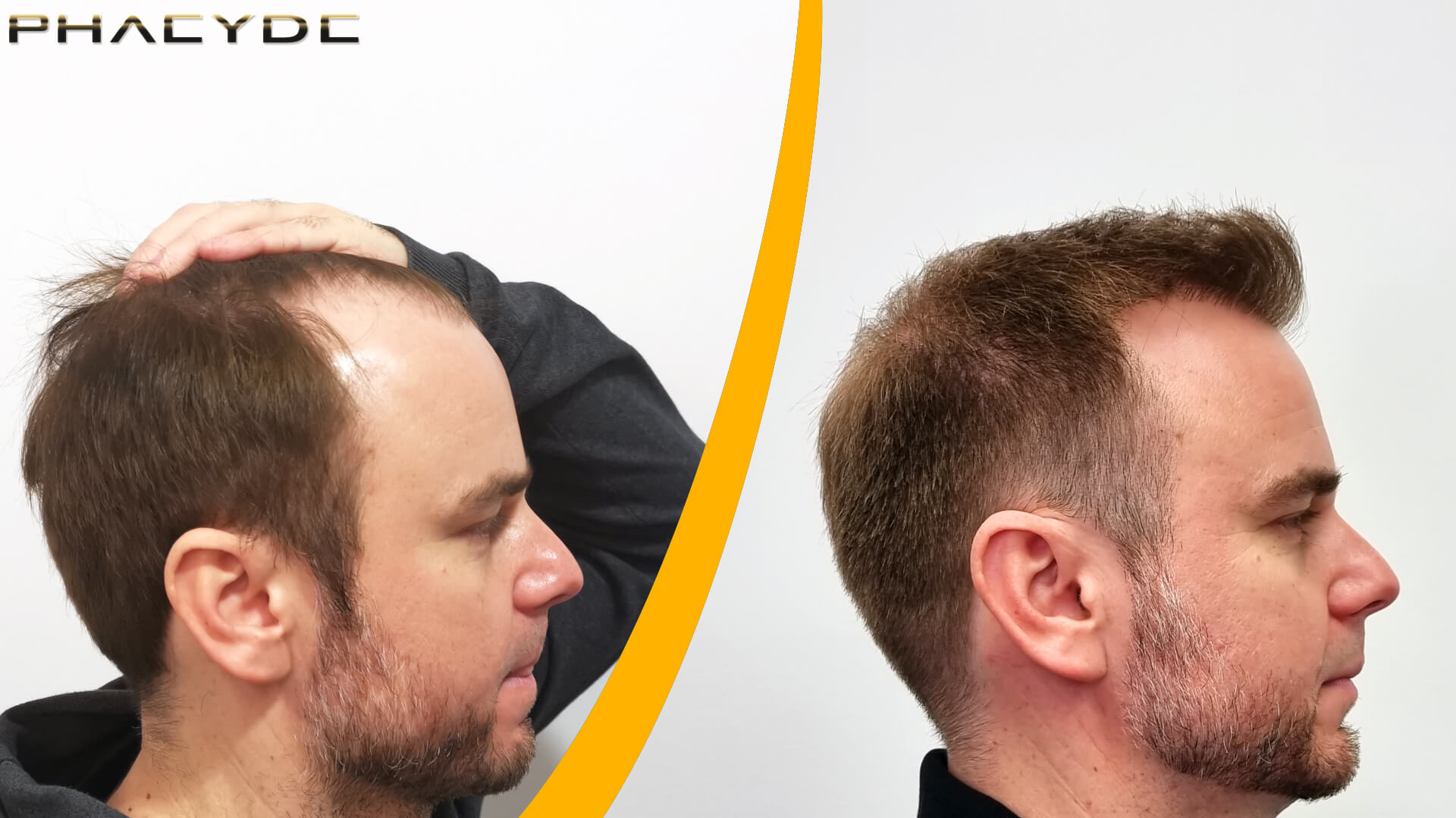 Before and After Hair Transplant
