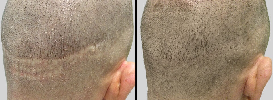 SMP (Scalp Micro Pigmentation) before and after