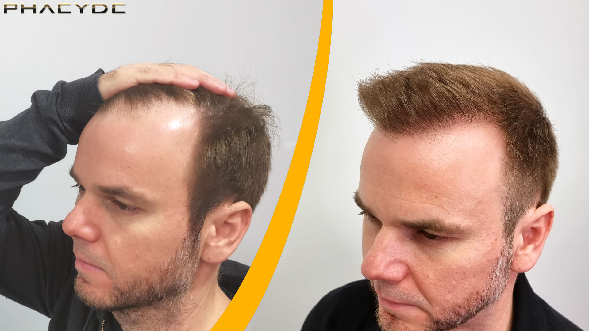 Before & After Hair Transplant