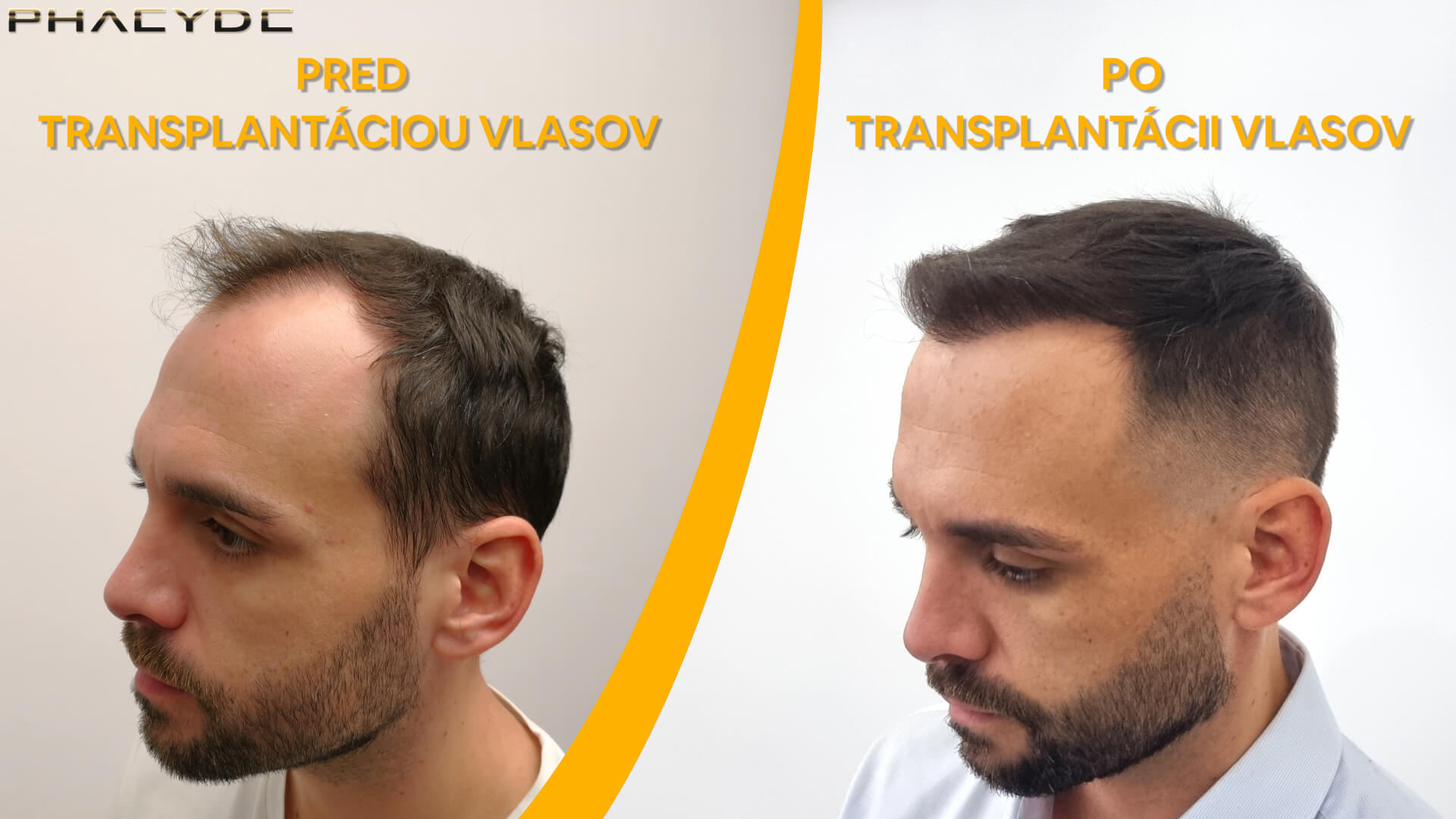 Hair transplant before-after: Balázs
