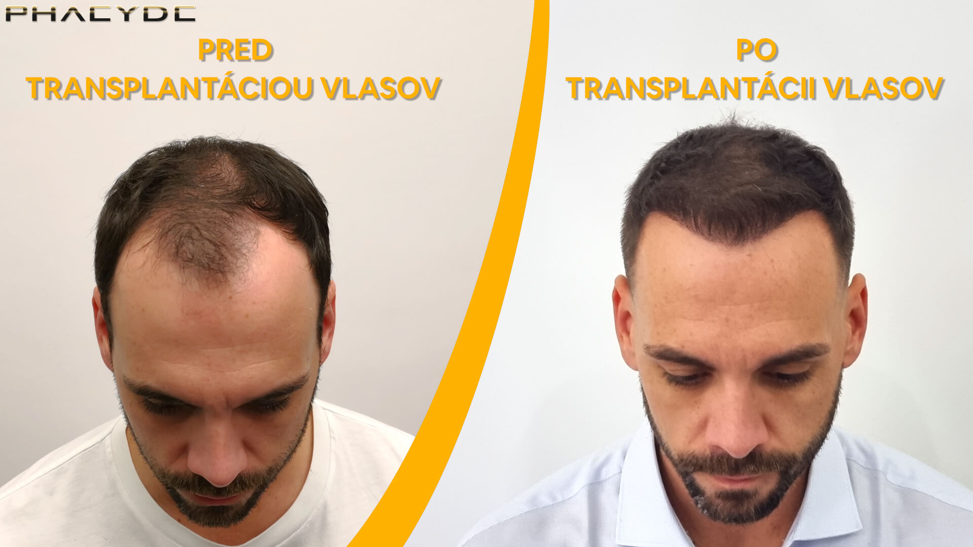 Hair transplant before-after: Balázs