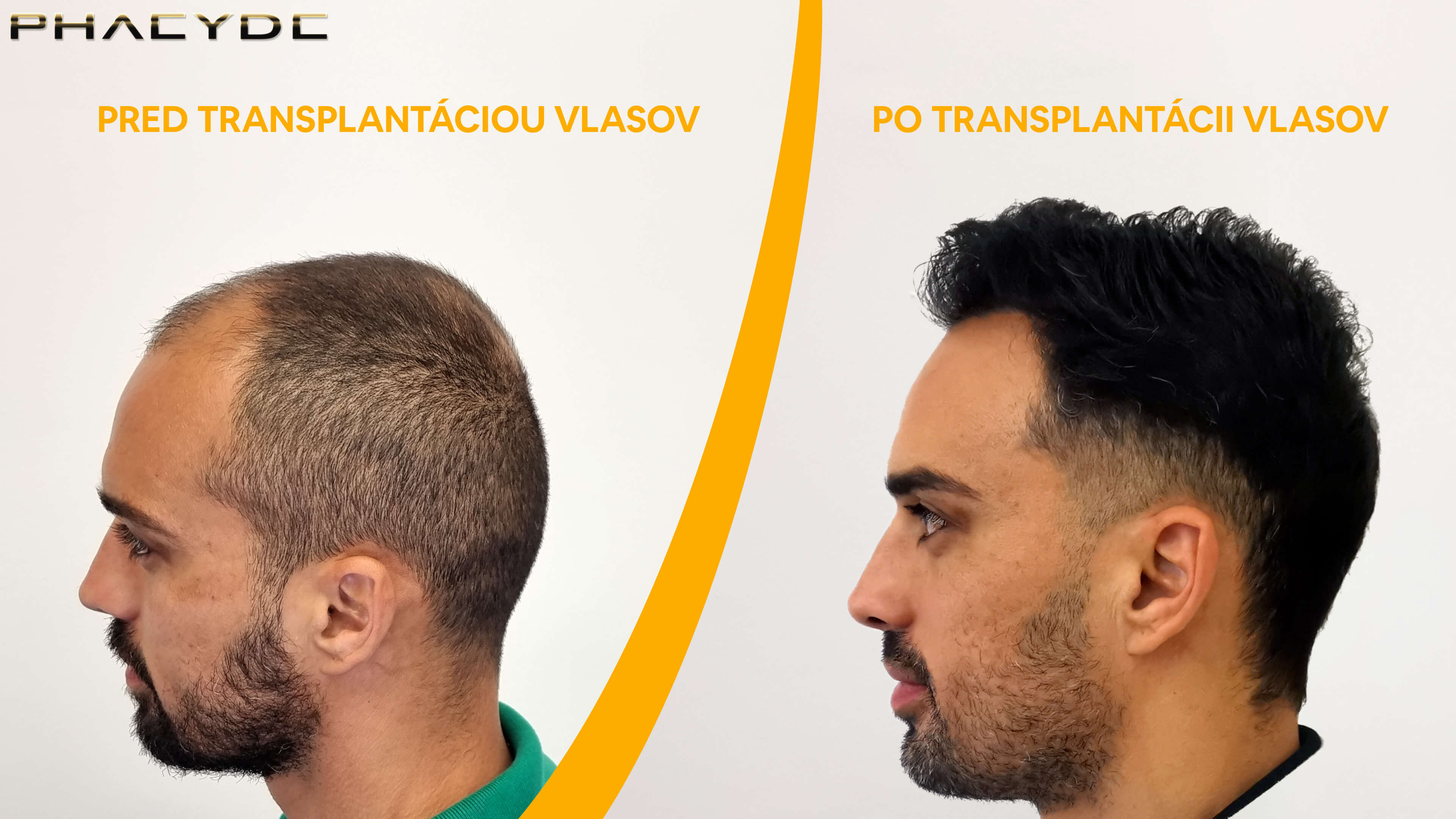 Hair transplant before-after: Lucas