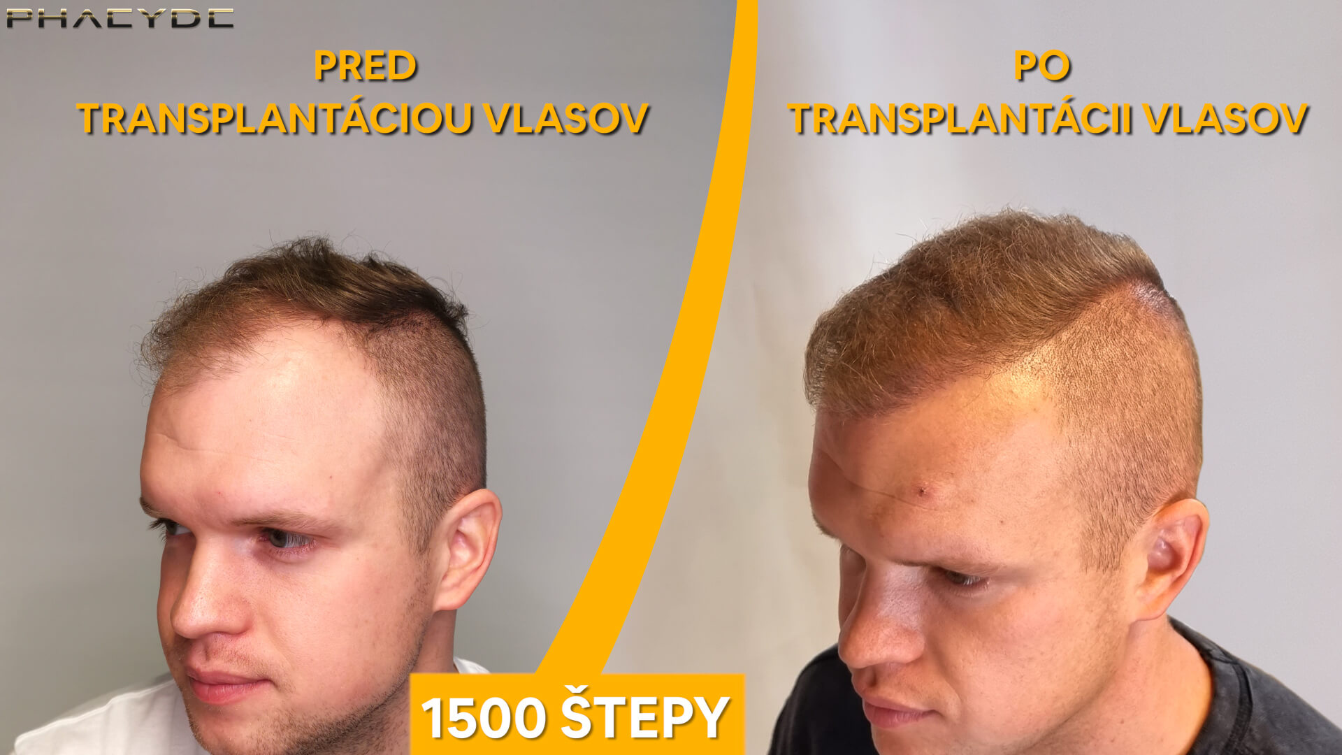 Hair transplant before-after: Patrik