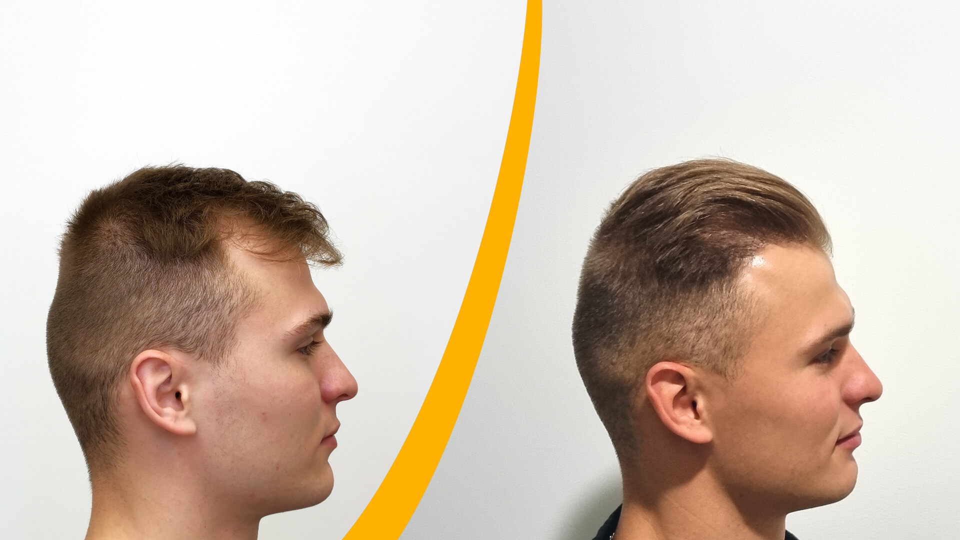 Hair Transplant – Before & After result