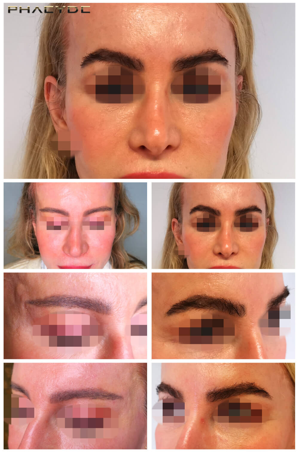 Eyebrow Transplantation